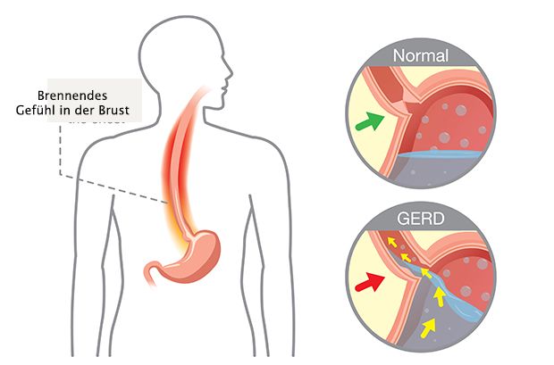 Refluxösophagitis Verlauf Symptome Behandlung Und Prävention